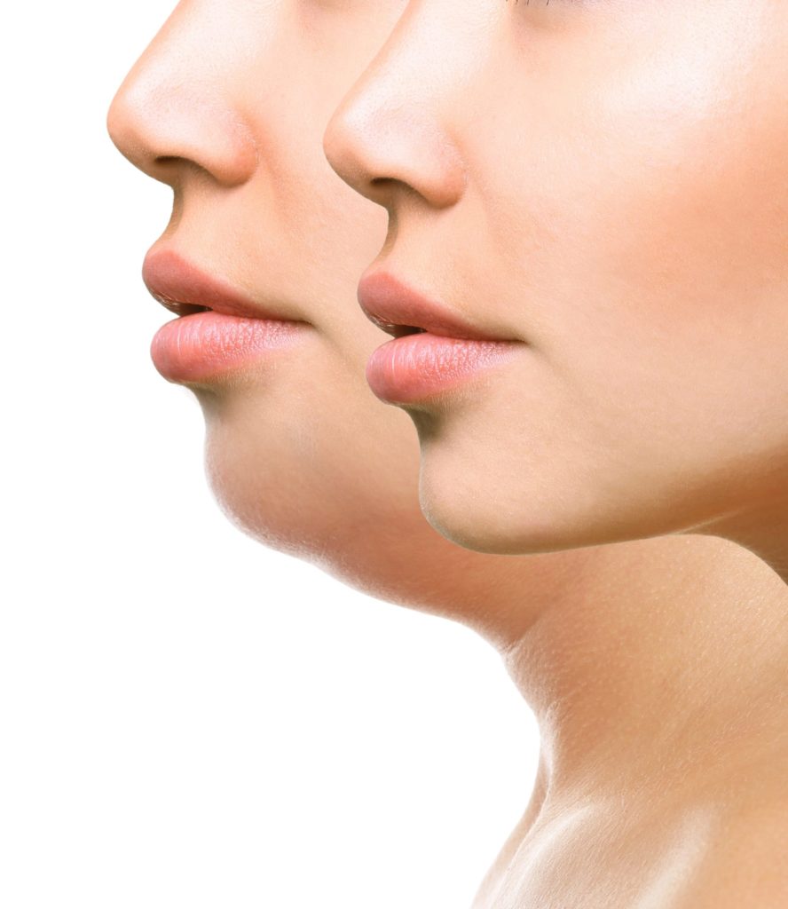 Kybella Injectables treatments In Fremont, CA: Ariba Medspa