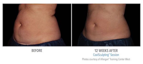 CS-Abdomen-Femail in Fremont, CA Ariba Medical Spa