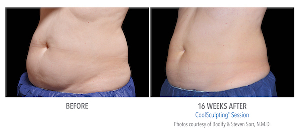 coolsculpting-female in Fremont, CA Ariba Medical Spa