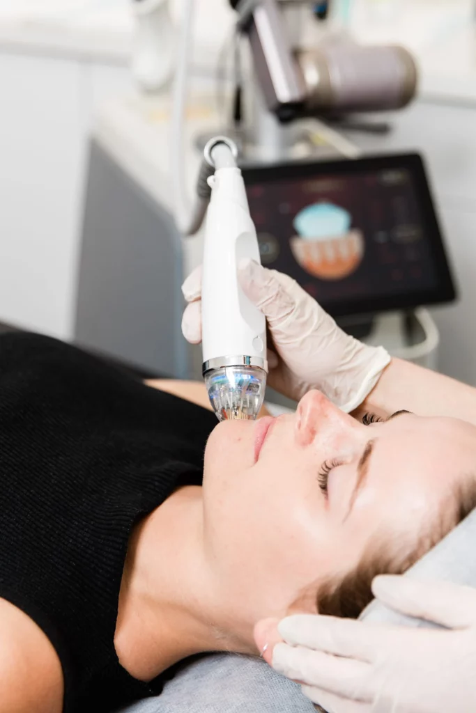 Vivace RF Microneedling Treatments In Fremont, CA | Ariba