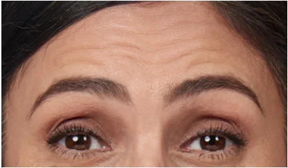 before-botox new in Fremont, CA Ariba Medical Spa