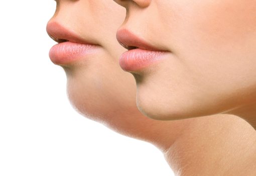 Kybella Injectables treatments In Fremont, CA: Ariba Medspa