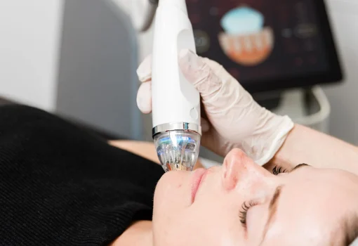 Vivace RF Microneedling Treatments In Fremont, CA | Ariba