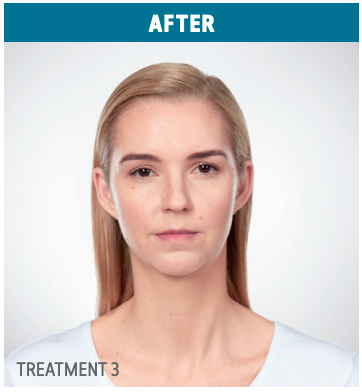 alisha-after1 in Fremont, CA Ariba Medical Spa Alisha-after1 in Fremont, CA Ariba Medical Spa