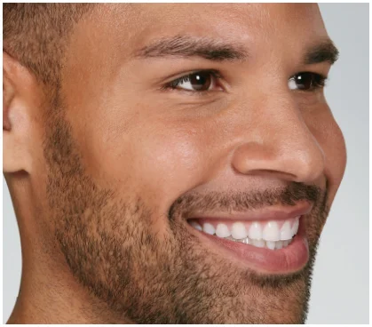 after-botox in Fremont, CA Ariba Medical Spa after-botox in Fremont, CA Ariba Medical Spa