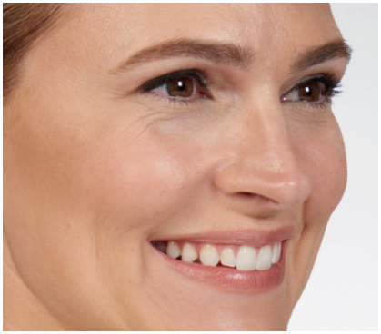 after-botox3 in Fremont, CA Ariba Medical Spa after-botox3 in Fremont, CA Ariba Medical Spa