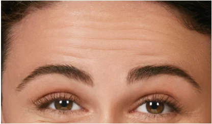 before-botox in Fremont, CA Ariba Medical Spa before-botox in Fremont, CA Ariba Medical Spa