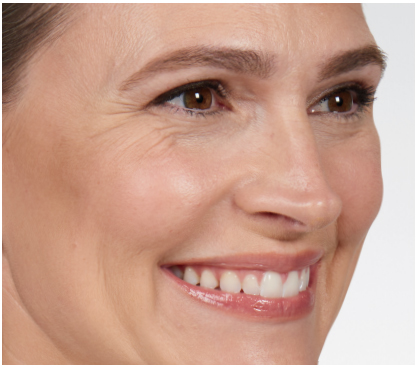 before-botox3 in Fremont, CA Ariba Medical Spa before-botox3 in Fremont, CA Ariba Medical Spa