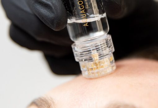 AQUAGOLD MICRONEEDLING in Fremont, CA AQUAGOLD MICRONEEDLING in Fremont, CA